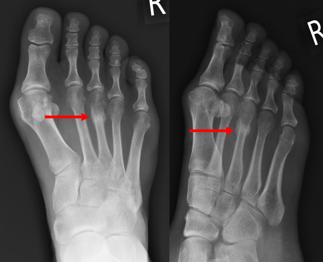 Stress Fractures | Ankle Fractures 