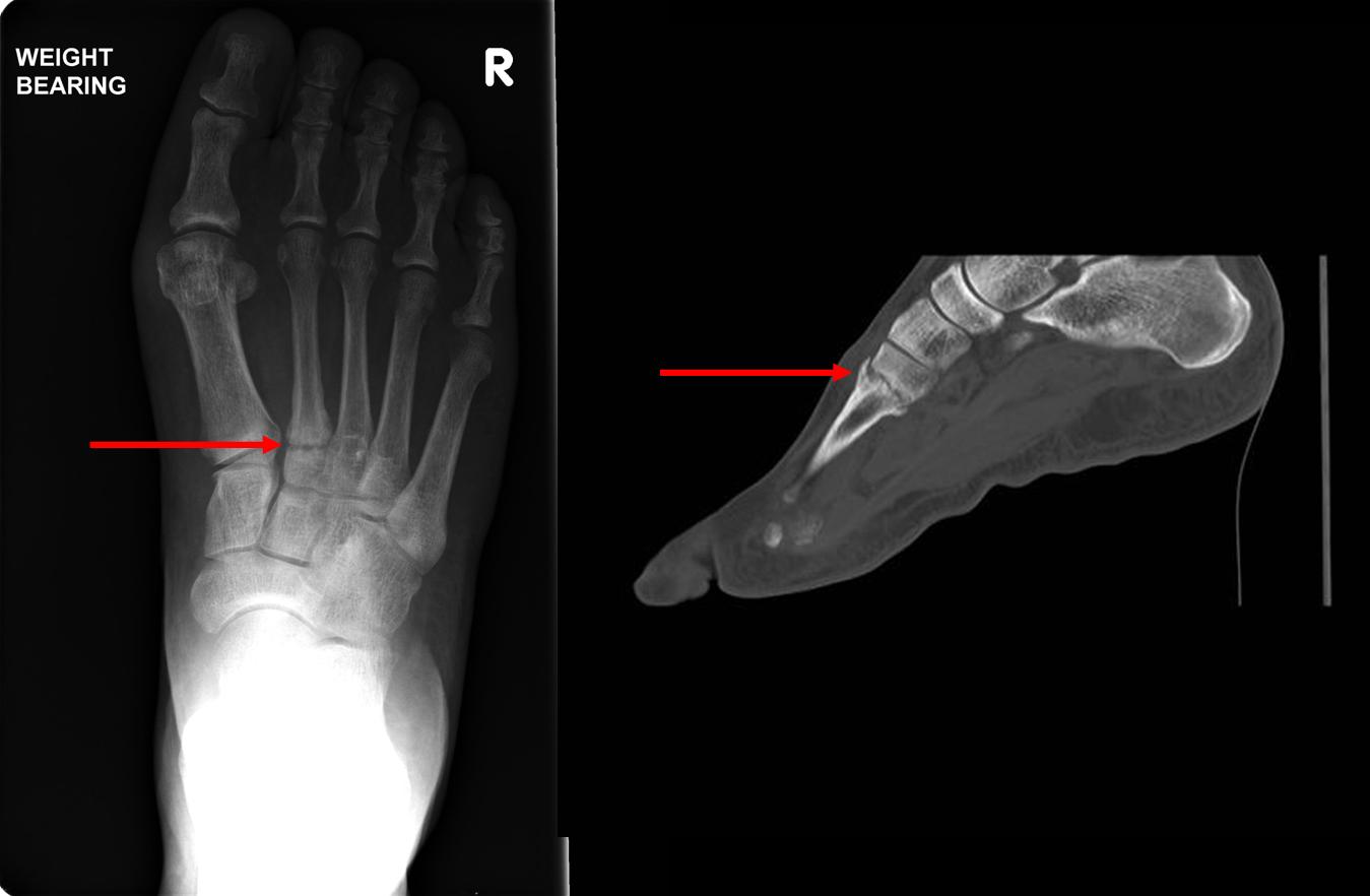 Stress Fractures Ankle Fractures Hertfordshire UK